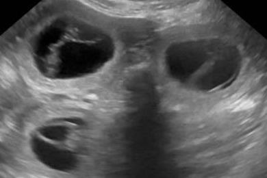 Ultraschallbild der Trächtigkeitsbestätigung bei Levi für den R-Wurf: mehrere dunkle Fruchtblasen im Bauchraum